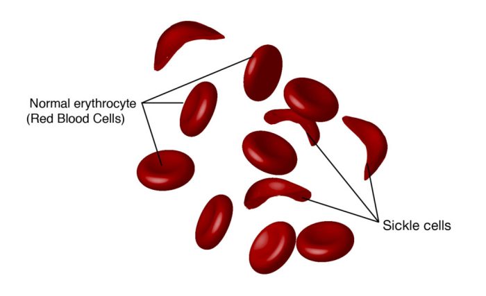 Sickle cell disease nclex questions